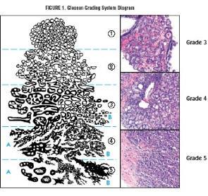 Gleason system of histologic prostate cancer staging Tumors assigned a primary grade based on predominant pattern