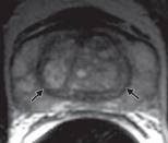 The NVB is in close, cage-like contact with seminal vesicles and prostate Prostate MRI Primary sequence is T2.