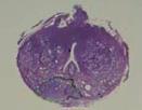 neurovascular bundle Tumor encasement of