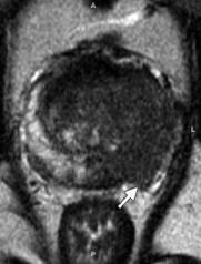 capsule Prostate MRI Seminal Vesicle