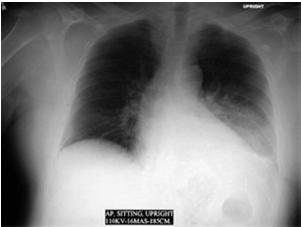Diagnosis Usually non-specific signs Fever and cough are hallmark Increased work of breathing may proceed the cough Impossible to differentiate between bacterial and viral Lung examination is