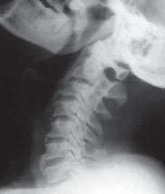 terior elements into the open position. One patient underwent Itoh s modification of Hirabayashi s technique, 8 in which bone graft from the rib was inserted to prevent closure of the hinged laminae.