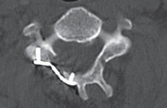 purely posterior compression. Cord changes were present in 19 cases. In 12 cases MRI films were available for the assessment of the cord changes.
