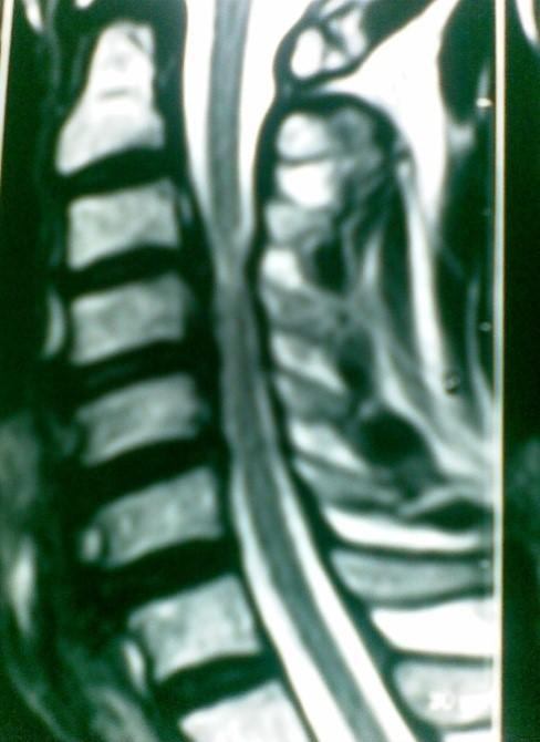 Decompressed spinal