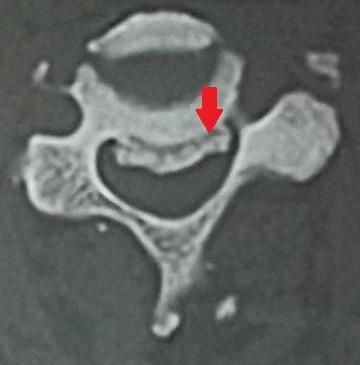 Lateral view Lateral Flexion and Extension view, will demonstrate narrowing of the disc space, osteophytes, spondylolisthesis, and instability[3].