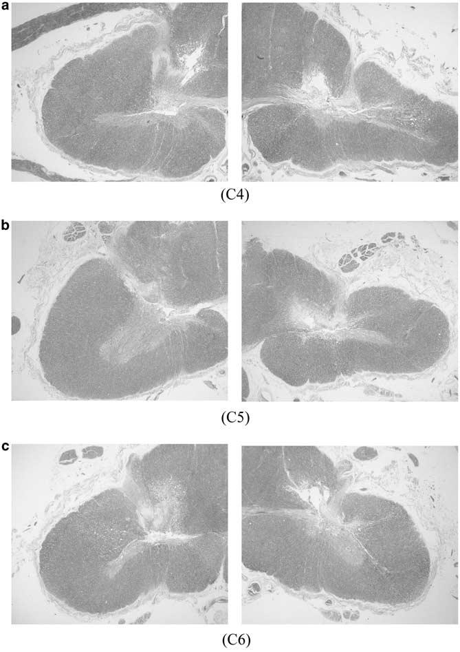 506 Figure 5 Higher power of photomicrographs at C4 (a), C5 (b) and C6 (c) showed severe flattening of the anterior horn with neuronal loss associated with intramedullary cystic necrosis (original