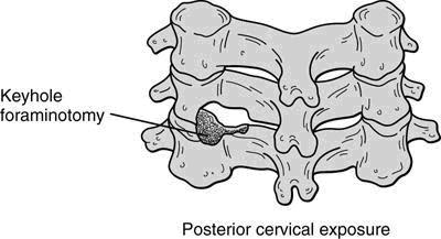 Cervical Spondylosis: Treatment Posterior