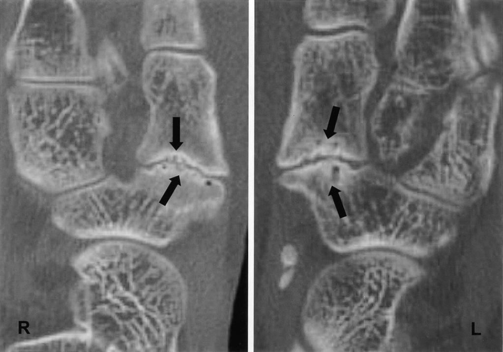 Subchondral sclerosis, subchondral cysts, beak-like spurs and a marked narrowing of the joint space, were believed to be a reactive bone change in fibrocartilaginous naviculo-medial cuneiform