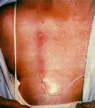 Tunnel infection: erythema and