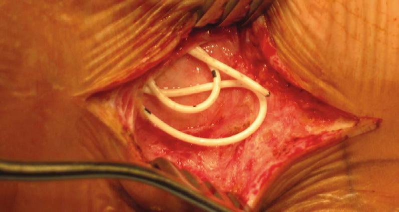 T.C. Li, M.H. Chen, J.S. Huang, et al medium in the subcutaneous layers (Figure 1B) and, as a result, surgery was planned to adjust the positioning of the catheter tip.