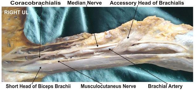 The brachialis is the muscle of the front of the arm region. It is situated behind the biceps brachii muscle.