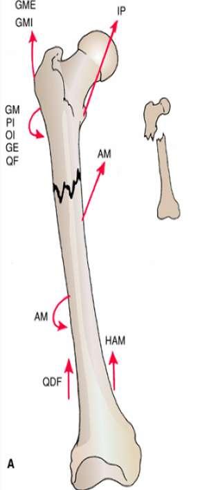 In fractures of the upper third of the shaft of the femur