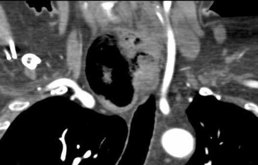 large diverticulum arising from the