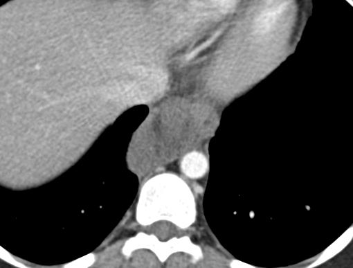 Duplication cyst with hemorrhage A Axial(A) and