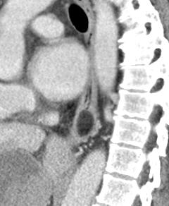 patient showing distal esophageal mass