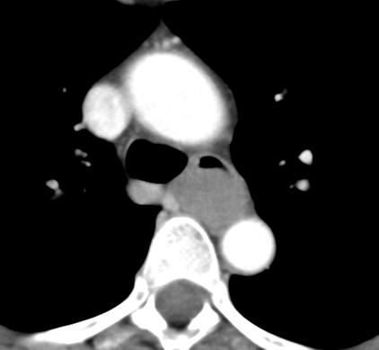 Esophageal leiomyoma A A C Sagittal(A)