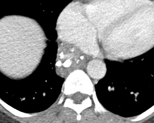 Esophageal AVM A Axial(A) and coronal() CT
