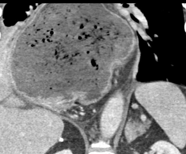 Hiatal hernia Coronal CT image reveals a large obstructed hiatal hernia