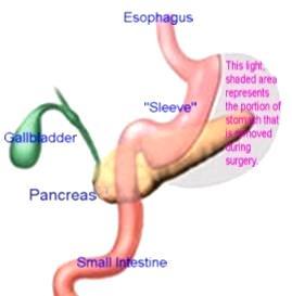 Laparoscopic Gastric Sleeve Resection Remove 80% Stomach Tube or Sleeve Like Stomach is left behind 70% Excess Weight