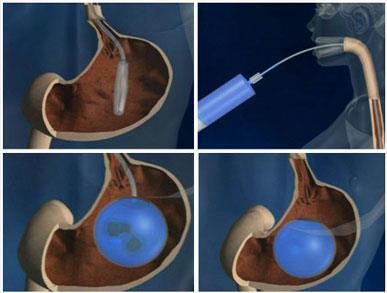 Intra Gastric Balloon Reduced Capacity Stomach Full Short Term /
