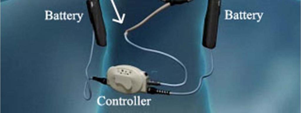continuous axial flow rests below diaphragm Device