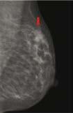 A biopsy should be considered when a lesion is visible only at MRI.
