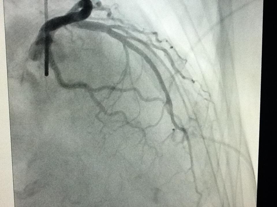 The septal artery is