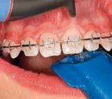 Plaque on the sub- and supragingival tooth surfaces is mechanically removed with Clinpro prophy powder - either in routine professional tooth cleaning or in addition to subgingival scaling during