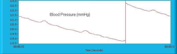 The mean arterial pressure (MAP) can be calculated from the systolic and diastolic pressures using the formula: MAP = 1/3 pulse pressure + diastolic pressure Instead of using a stethoscope, blood