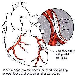 Figure 4. The effects of atherosclerosis on arteries in the heart cause CHD Angina (chest pain) is a result of partial blockages of coronary arteries due to CHD.