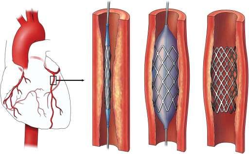 The non-surgical intervention is called angioplasty, which is a medical term to describe the procedure in which narrow coronary arteries are widened using a tiny balloon that is inflated to widen the