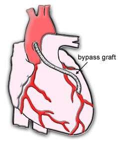 Figure 6. Bypass surgery A bypass graft (a replacement artery) is placed to avoid blood flow through a narrowed or blocked coronary artery.
