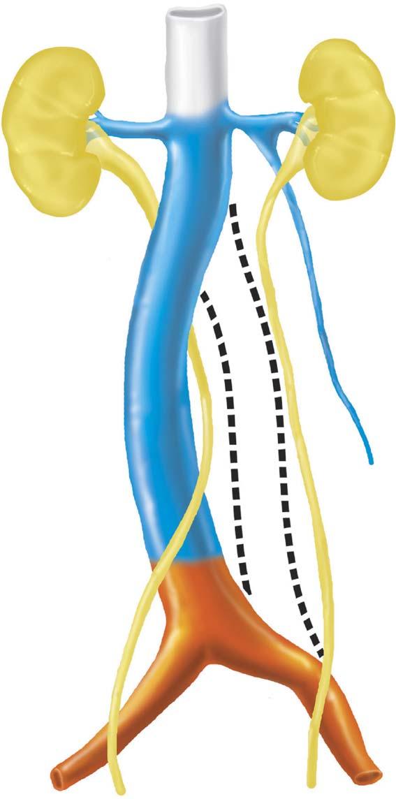 european urology supplements 5 (2006) 444 448 447 the left gonadal vein. Hence the right subcardinal vein becomes the main drainage channel and develops into the renal segment of the IVC (Fig. 5).