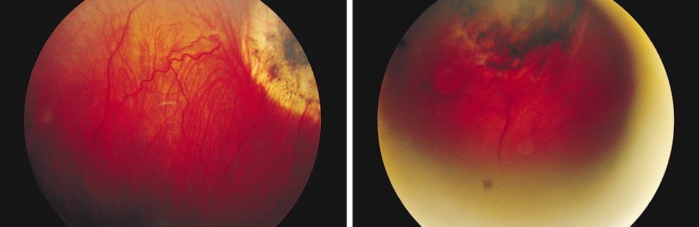 Ocular Complications of Retinal Angiomatosis Table 1. Ocular Complications Due to Retinal Angiomatosis in VHL Gene Carriers* Complication No.