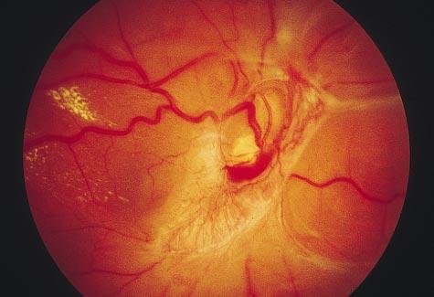 Neovascularization Disc 5 Periphery 4 *VHL indicates von Hippel-Lindau. Of 193 eyes with retinal angiomatosis, no data were available on the complications occurring in 6 of 199 eyes with angiomatosis.