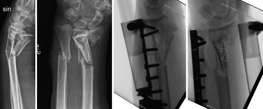 Treatment of Distal Radial Fractures 1687 Fig. 9 External fixation.