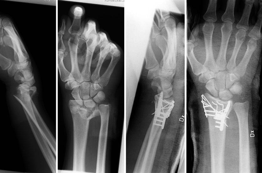 Treatment of Distal Radial Fractures 1689 Fig.