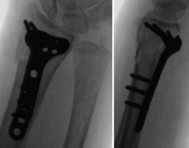 1690 P. Kopylov et al. Fig. 12 Fracture treated with a volar plate combined with a bone graft or bone substitute to fill the gap caused by the impacted osteoporotic bone [34, 35].