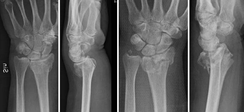 Treatment of Distal Radial Fractures 1677 Fig. 1 Different aspects of DRF. On the left side a two- part fracture without involvement of the articular surface and no volar comminution.