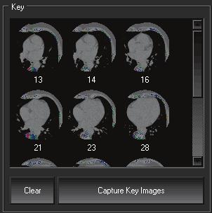 Capturing key images Capturing key images Produce a calcium score (see page 54). Then, click the Calcium Scoring button to select Calcium Scoring mode, and click the Image Capture button.