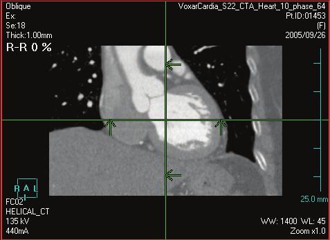 4D Review and LV Analysis Set up the chamber views 1 Position the mouse pointer over the upper-left MPR view, and rotate the mouse wheel to cine to the aortic
