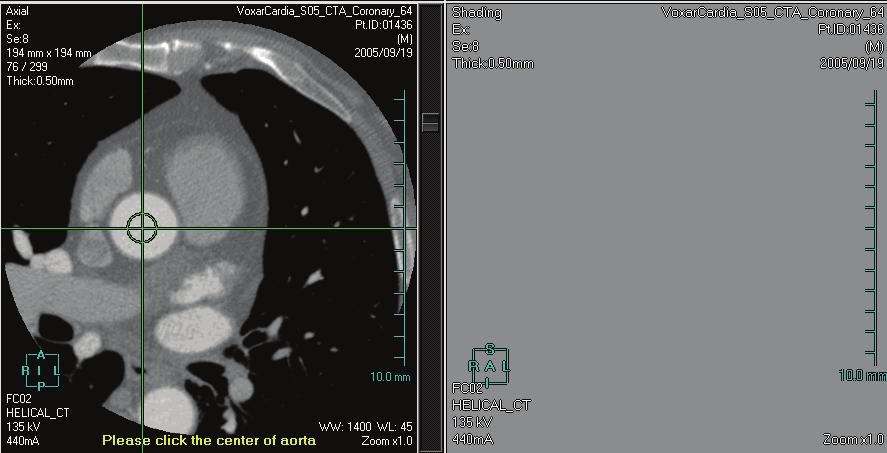 4D Review and Coronary Analysis 3 In the axial MPR view, click the center of the aorta to position the crosshairs. 4 Click the Extract button.