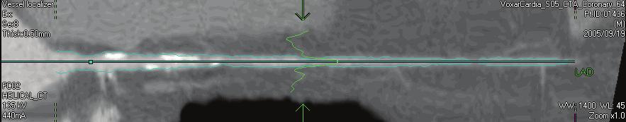 4D Review and Coronary Analysis 3 In the vessel localizer view, drag one of the green arrows along the artery to cine through the images to identify any center-lines or contours that you want to edit.