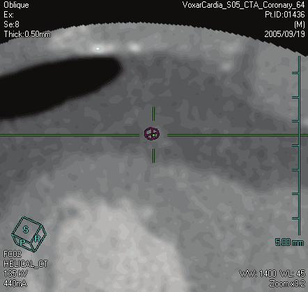 4D Review and Coronary Analysis 10 In the oblique MPR view, modify