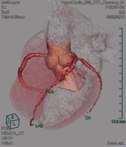 4D Review and Coronary Analysis In the 3D view, the aortic root