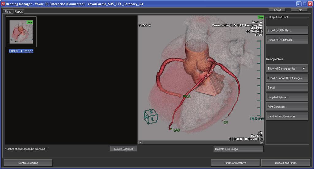 4D Review and Coronary Analysis 3 To return to CardiaMetrix Coronary Analysis, click the Continue reading button.