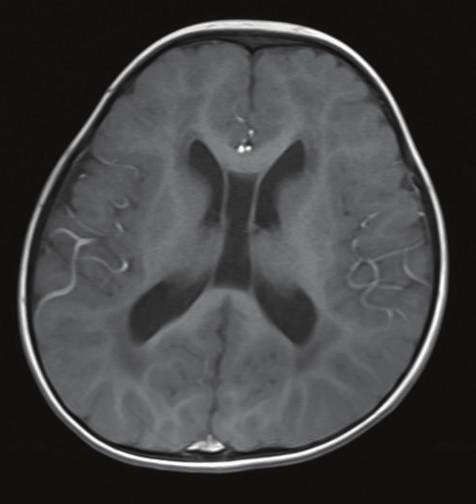 4 Biomedical Imaging (a) (b) (c) (d) (e) (f) Figure 1: MR imaging of a representative patient with SNHL.