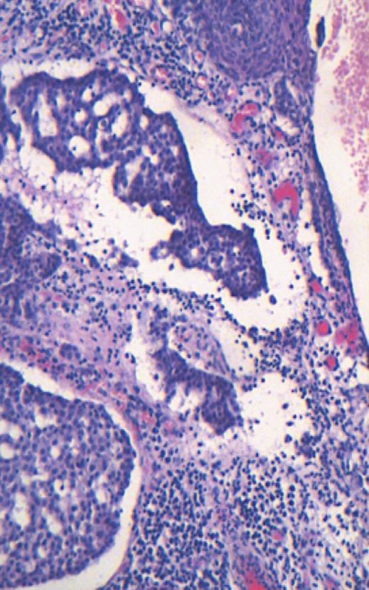 2 (c) Figure 1: Cribriform pattern of apocrine adenocarcinoma. Original magnification: 100, hematoxylin/eosin stain.
