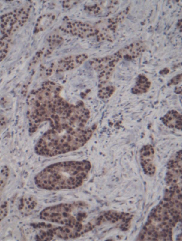3 Figure 2: Immunostaining for androgen receptor. Intense nuclear staining in the overwhelming majority of tumor cells. Immunostaining for Human Epidermal growth factor Receptor-2 (HER2). Score 3+.