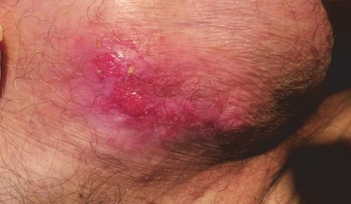 cancer often manifested as scrotal eczema and/or dermatitis with pruritus.